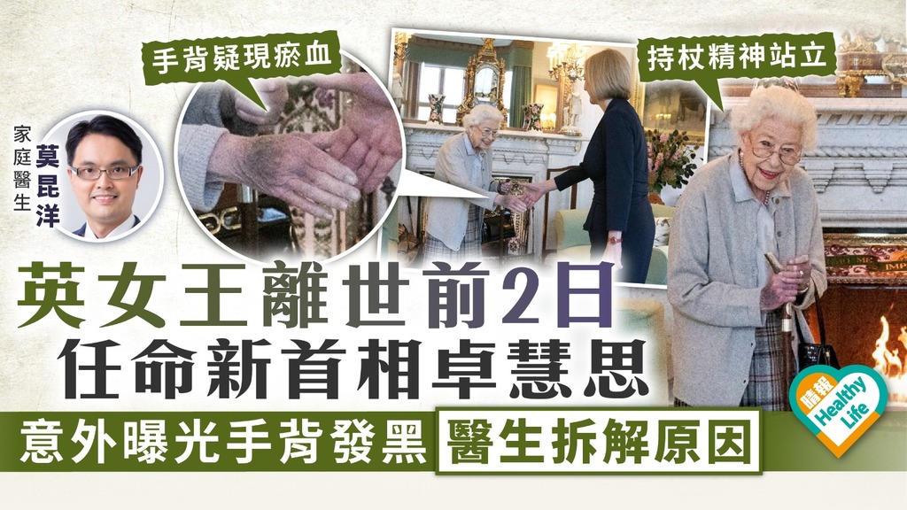 英女王逝世︳英女王離世前2日任命新首相卓慧思 意外曝光手背發黑醫生拆解原因