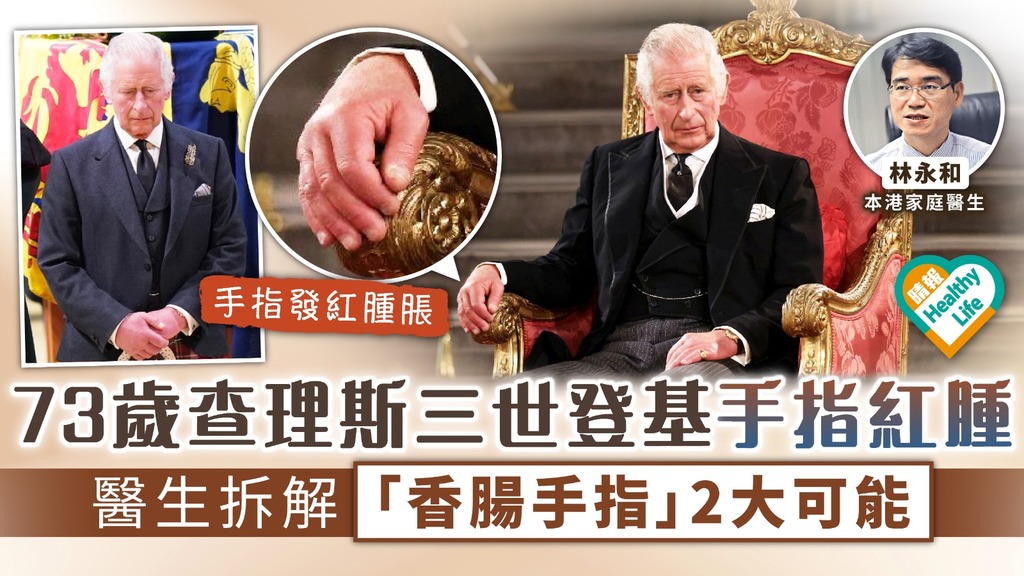英女王逝世︳73歲英王查理斯三世登基手指發紅腫脹 醫生拆解「香腸手指」兩大可能