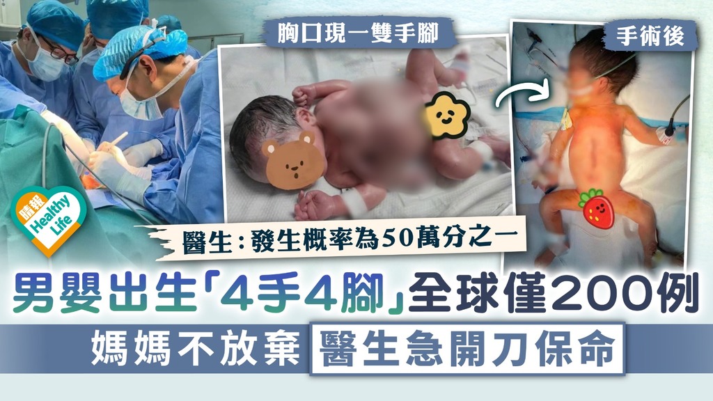 寄生胎︳男嬰出生現4手4腳全球僅200例 媽媽不放棄醫生急開刀保命