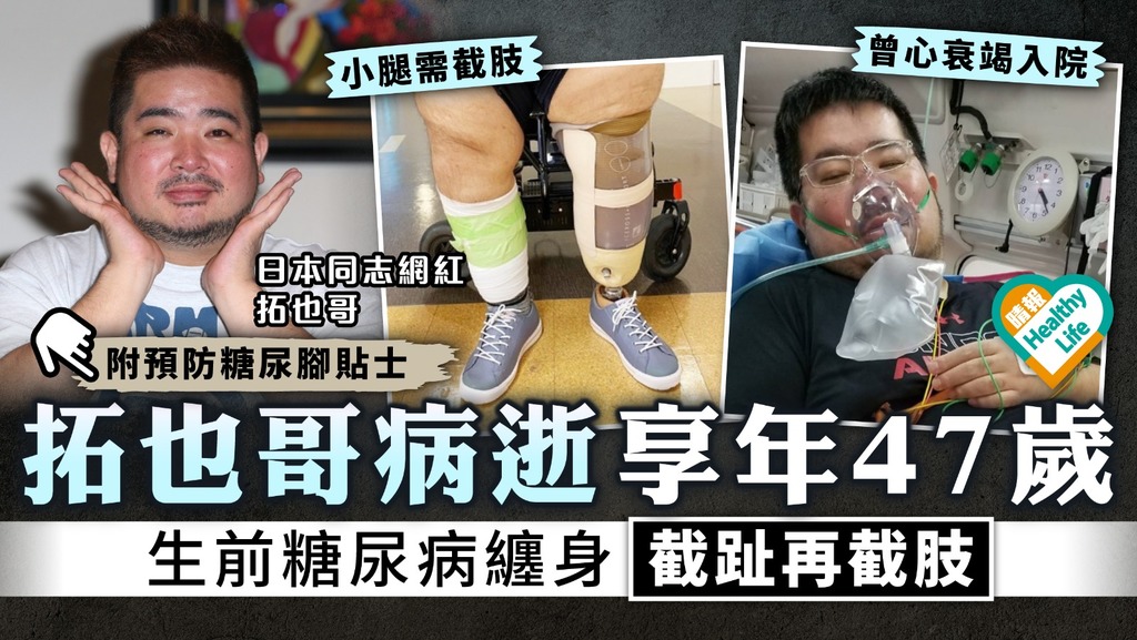 糖尿病︳日本網紅拓也哥病逝享年47歲 生前糖尿病纏身截趾再截肢︳附預防糖尿腳貼士
