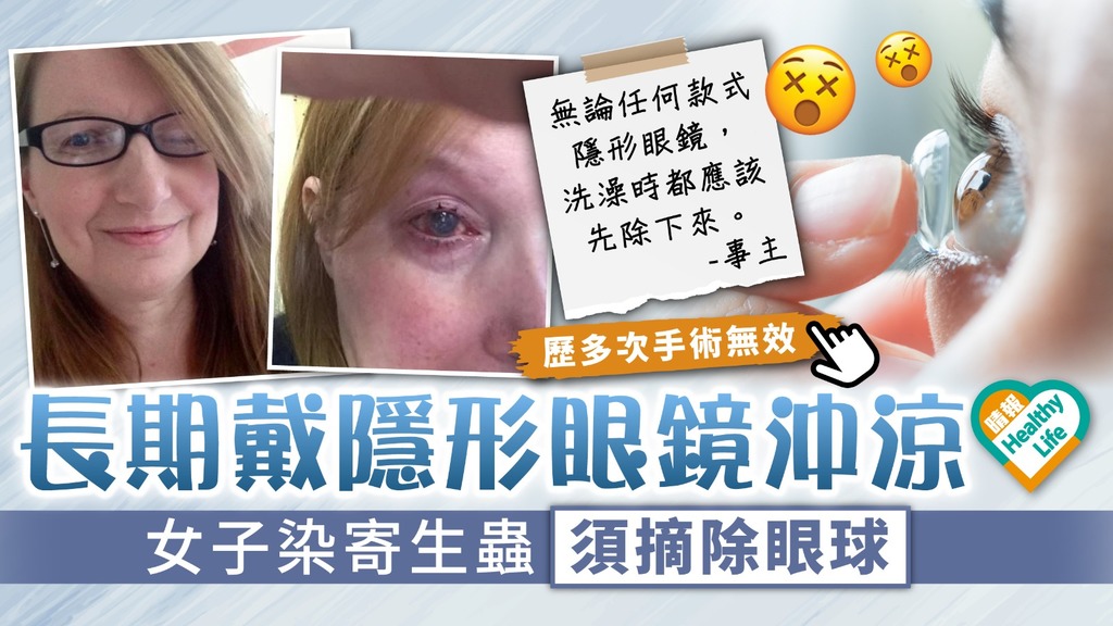 隱形眼鏡 ︳長期戴隱形眼鏡沖涼 女子染寄生蟲須摘除眼球