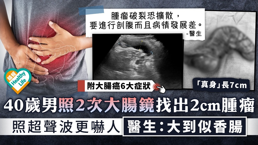 大腸癌︳40歲男照2次大腸鏡找出2cm腫瘤 照超聲波更嚇人 醫生：大到似香腸︳附6大徵狀+5招預防