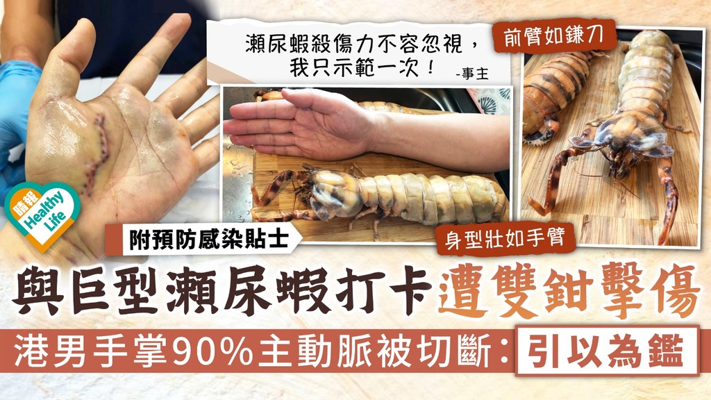 食用安全︳與巨型瀬尿蝦打卡遭雙鉗擊傷 港男手掌90%主動脈被切斷：引以為鑑︳附8招預防感染