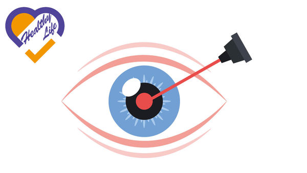 激光治療青光眼 有效降眼壓