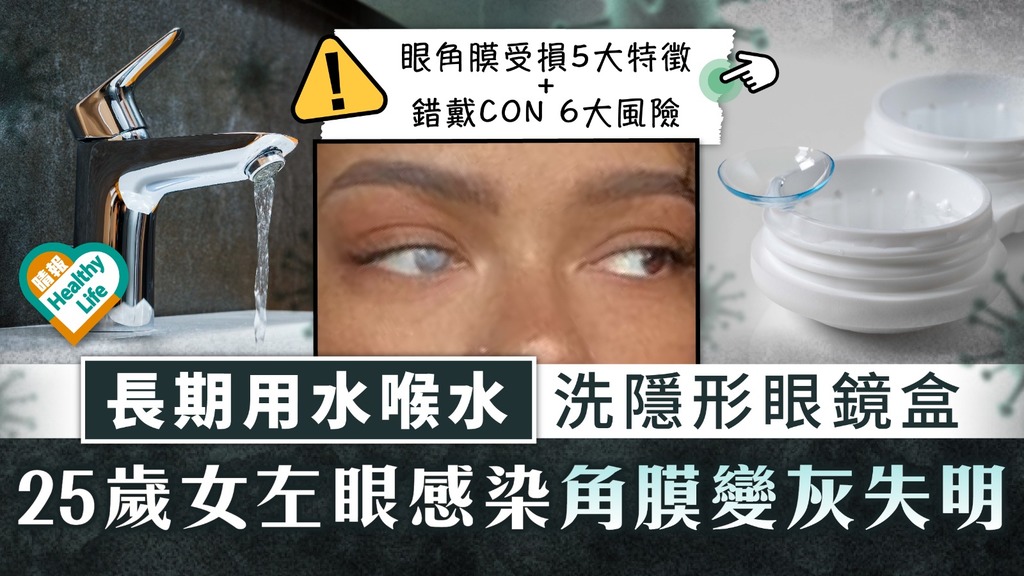危險習慣︳長期用水喉水洗隱形眼鏡盒 25歲女左眼感染角膜變灰失明︳附錯戴CON 6大風險