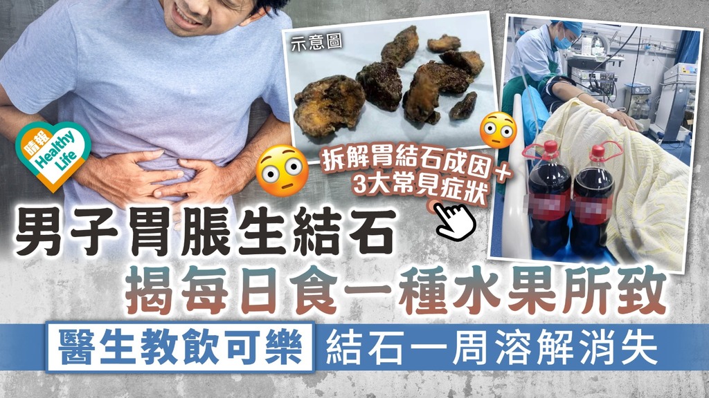 食用安全︳男子日食一種水果致胃脹生結石 醫生教飲可樂結石一周溶解消失︳附胃結石常見症狀