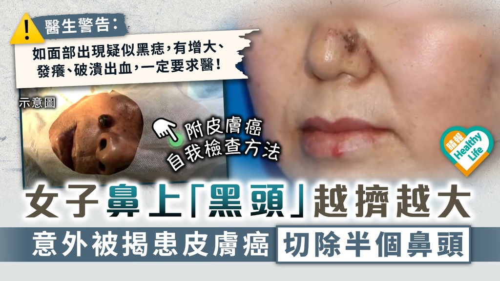 皮膚癌︳女子鼻上「黑頭」越擠越大 意外被揭患皮膚癌切除半個鼻頭︳附醫生拆解