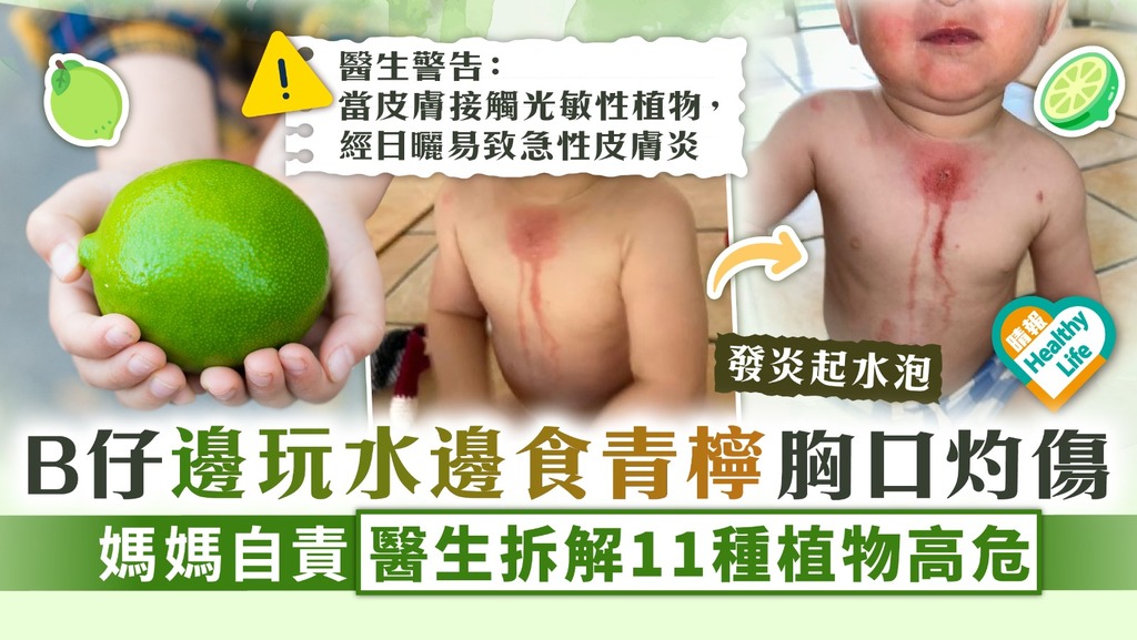 食用安全︳B仔邊玩水邊食青檸胸口灼傷 媽媽自責醫生拆解11種植物高危