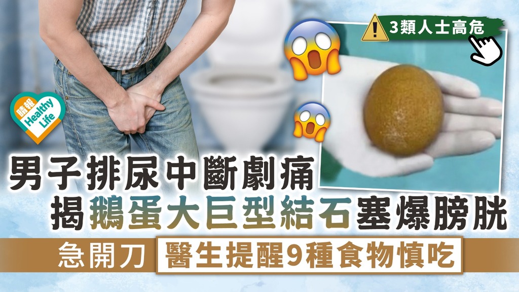 男人最痛︳男子排尿中斷劇痛 揭「鵝蛋大」巨型結石塞爆膀胱急開刀 醫生提醒9種食物慎吃