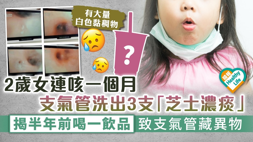 食用安全︳2歲女連咳一個月 支氣管洗出3支「芝士濃痰」 揭半年前喝一飲品致支氣管藏異物︳附6類高危鯁喉食物