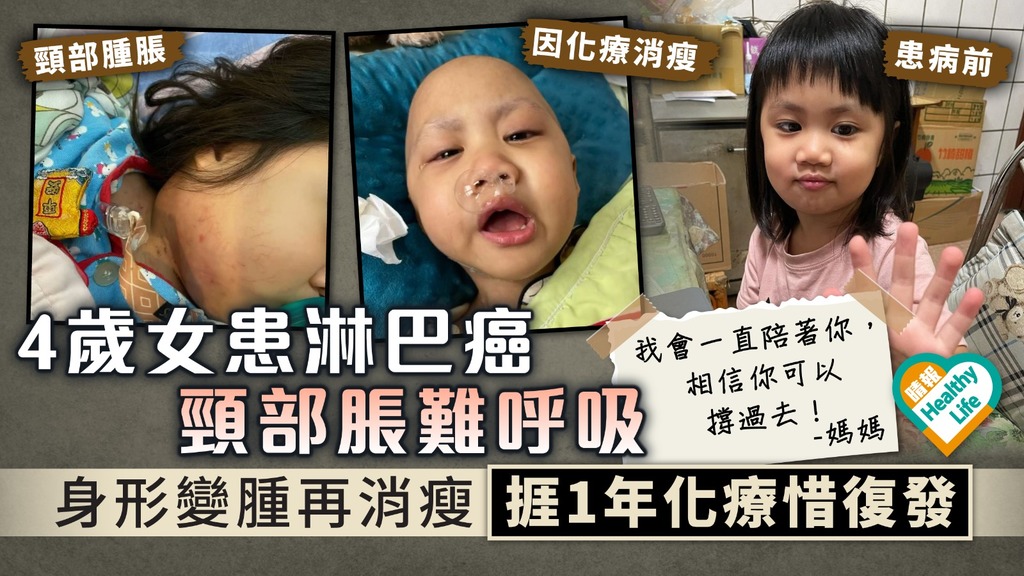 令人心痛︳4歲女患淋巴癌頸部脹難呼吸 身形變腫再消瘦捱1年化療惜復發