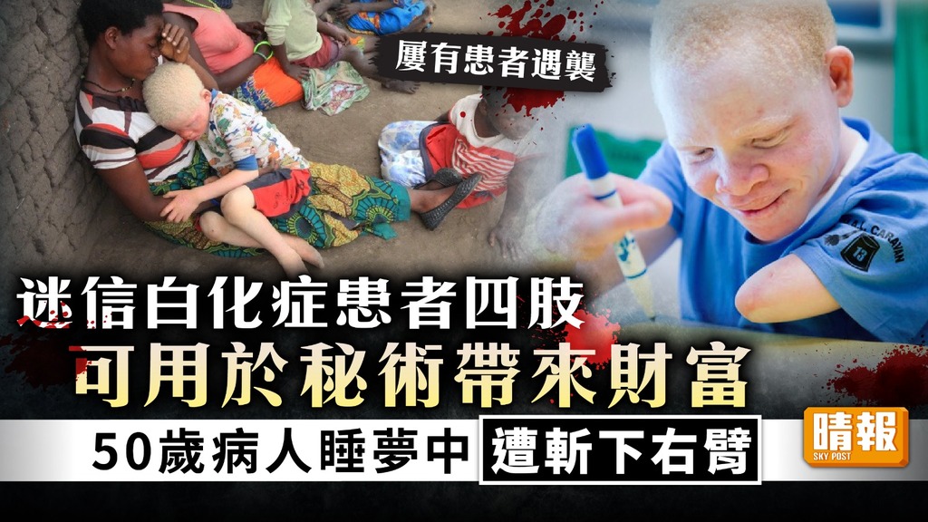 白化症 ︳迷信白化症患者四肢可用於秘術帶來財富 50歲病人睡夢中遭斬下右臂