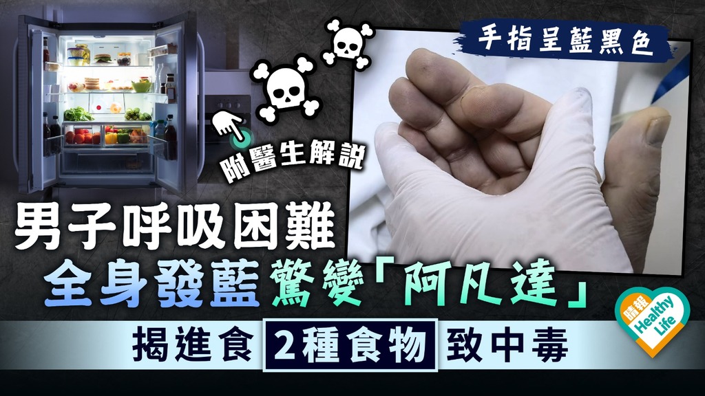 食用安全︳男子呼吸困難 全身發藍驚變「阿凡達」 揭進食2種食物致中毒