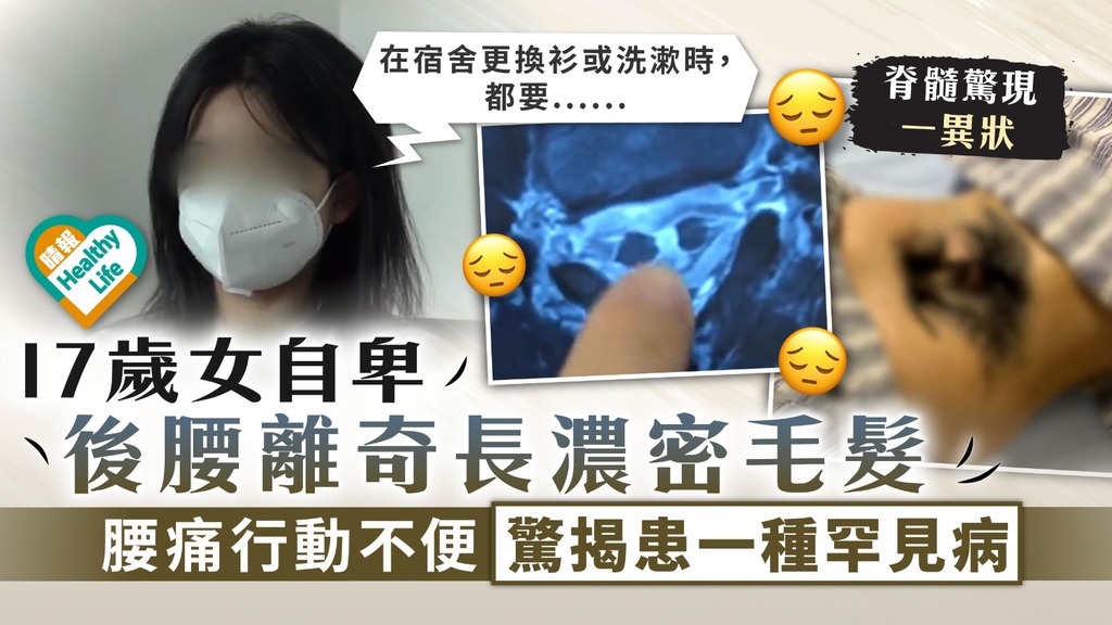 羞於啟齒︳17歲女自卑 後腰離奇長濃密毛髮 腰痛行動不便驚揭患一種罕見病