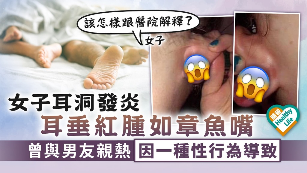 愛得轟烈︳女子耳洞發炎耳垂紅腫如章魚嘴 曾與男友親熱因一種性行為導致