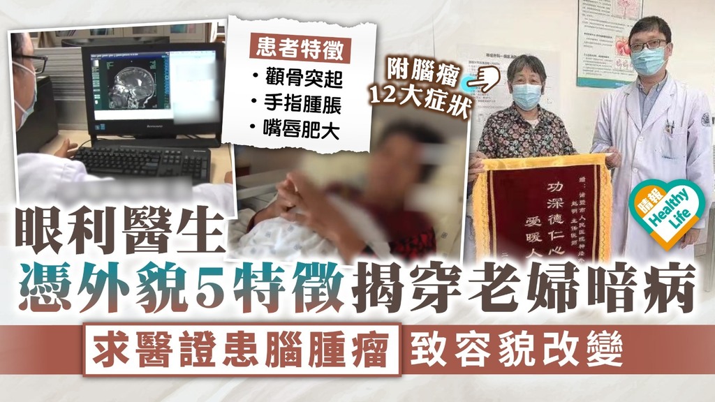 好人好事︳眼利醫生憑外貌5特徵揭穿老婦暗病 求醫證患腦腫瘤致容貌改變