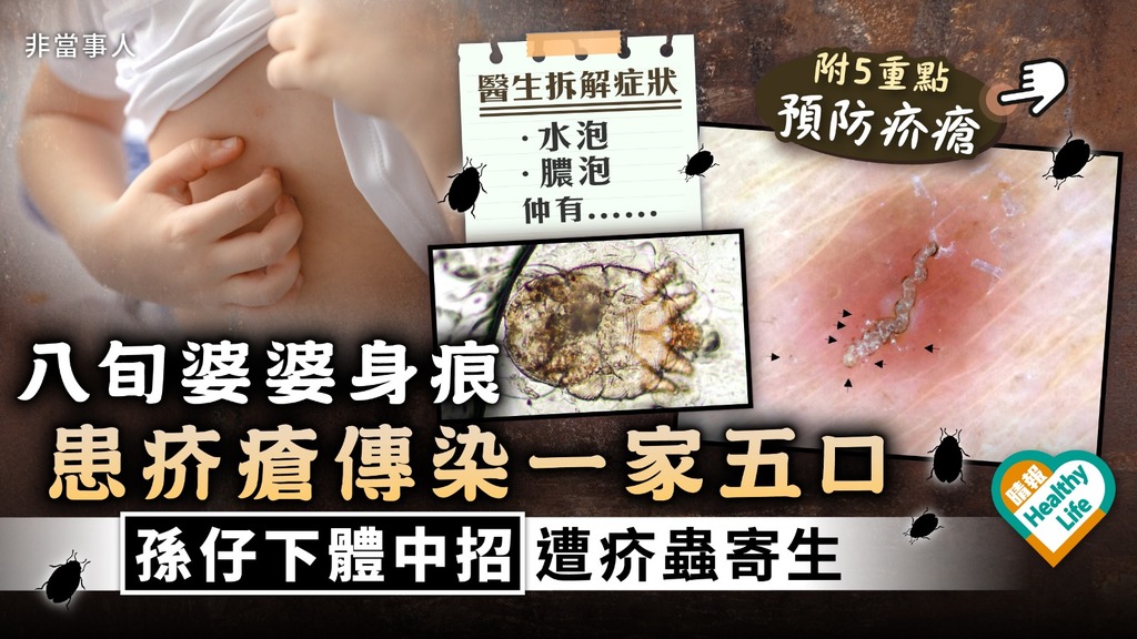 寄生蟲纏身︳八旬婆婆身痕 患疥瘡傳染一家五口 孫仔下體中招遭疥蟲寄生