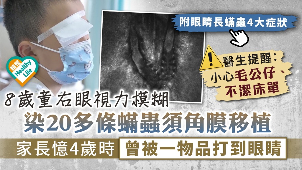 蟎蟲入眼︳8歲童右眼視力模糊 揭感染20多條蟎蟲須角膜移植 家長憶4歲時曾被一物品打到眼睛︳附4大症狀