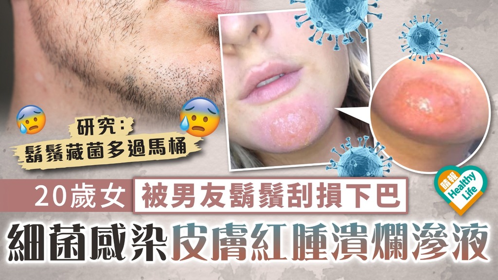 個人衛生︳20歲女被男友鬍鬚刮損下巴 細菌感染皮膚紅腫潰爛滲液