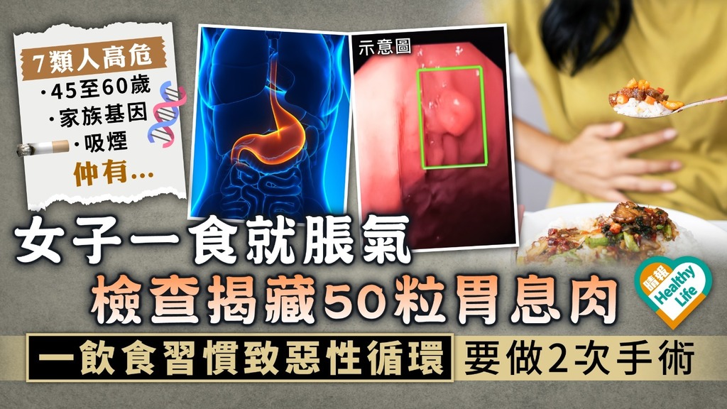 胃底腺瘤︳女子一食就脹氣 檢查揭藏50粒胃息肉 一飲食習慣致惡性循環要做2次手術︳附胃息肉7類高危人士