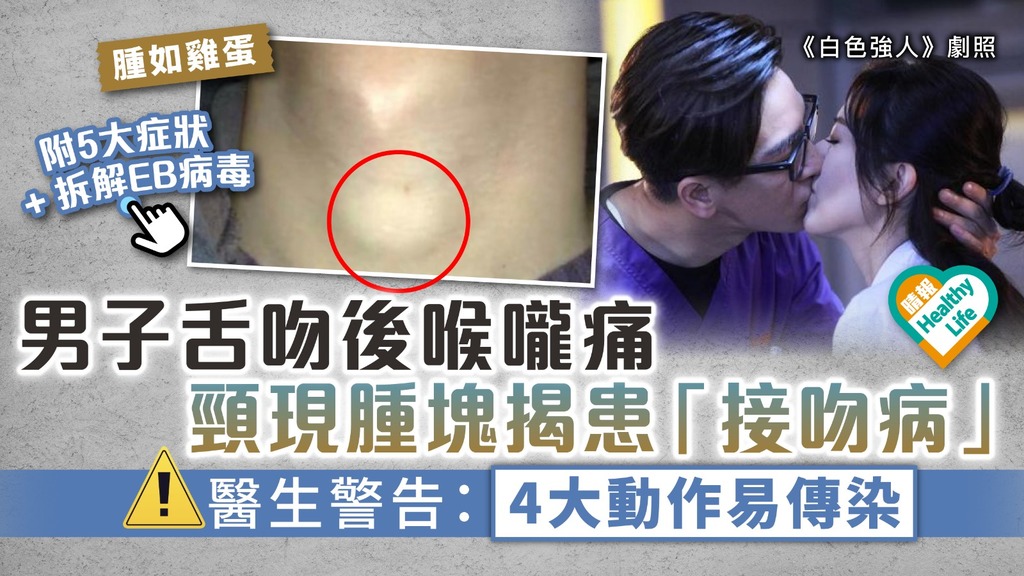 EB病毒︳舌吻後喉嚨痛頸現腫塊 男子感染病毒患「接吻病」 醫生警告：4大動作易傳染︳附5大症狀