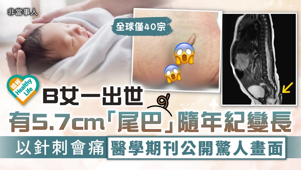 罕見病︳B女一出世有5.7cm「尾巴」 隨年紀變長以針刺會痛 醫學期刊公開驚人畫面