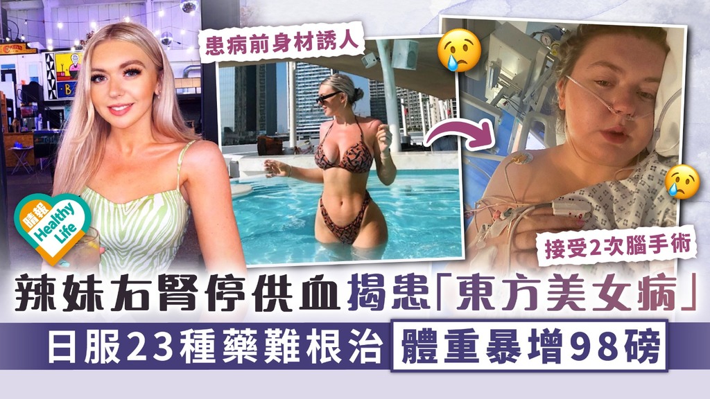 罕見病︳辣妹右腎停供血揭患「東方美女病」 日服23種藥難根治 體重暴增98磅