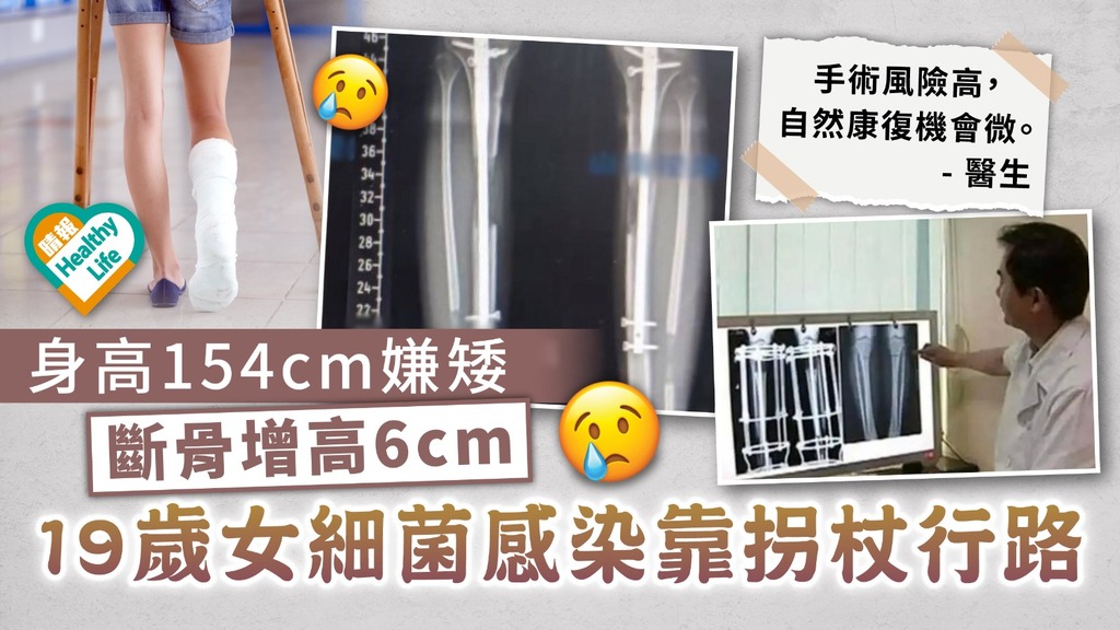 增高手術 ︳19歲女高154cm嫌矮斷骨增高6cm 術後細菌感染靠拐杖行路