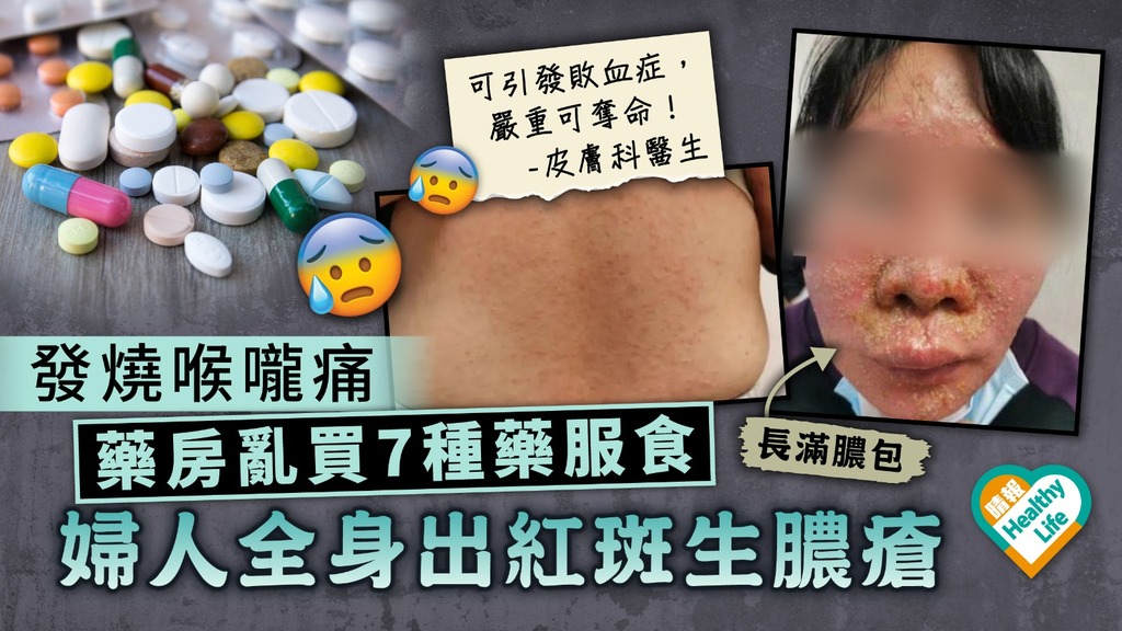 藥物過敏 ︳婦人發燒喉嚨痛 藥房亂買7種藥服食致全身出紅斑生膿瘡