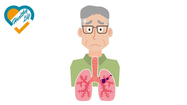 中大研「3合1」療法 肺癌存活率倍增