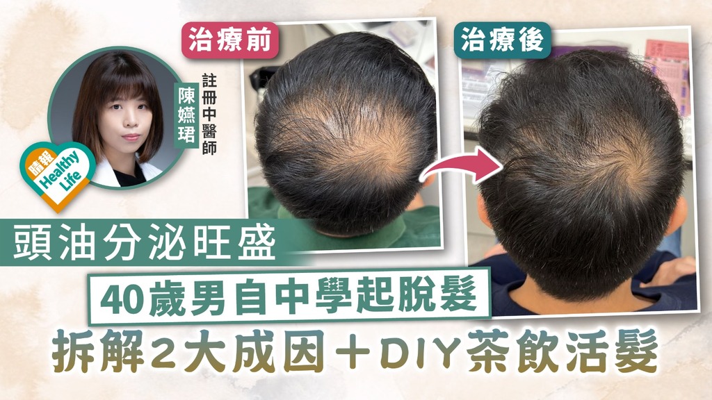 男士脫髮︳頭油分泌旺盛 40歲男自中學起脫髮 中醫拆解2大成因＋DIY茶飲活髮