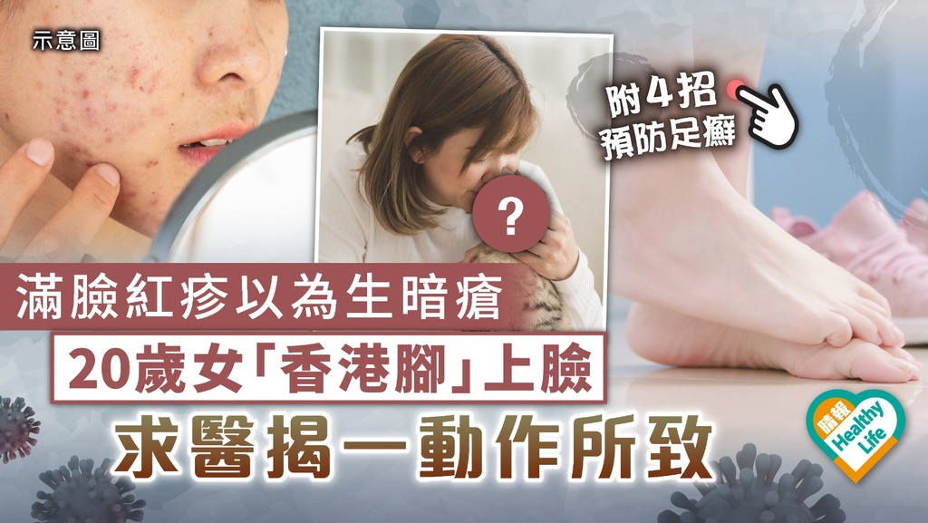 真菌感染︳滿臉紅疹以為生暗瘡 20歲女「香港腳」上臉 求醫揭一動作所致︳附4招預防足癬