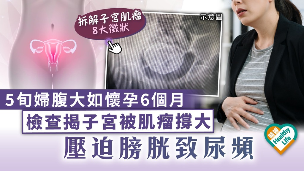 女士注意︳5旬婦腹大如懷孕6個月 檢查揭子宮被肌瘤撐大 壓迫膀胱致尿頻