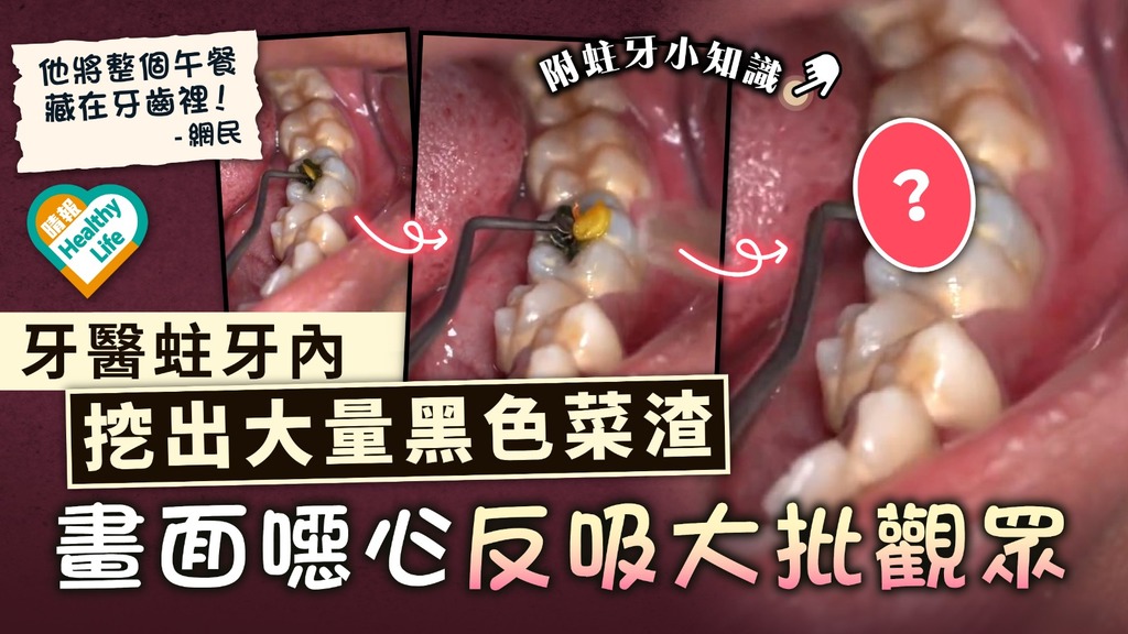 牙齒健康 ︳牙醫蛀牙內挖出大量黑色菜渣 畫面噁心反吸大批觀眾 ︳附蛀牙小知識