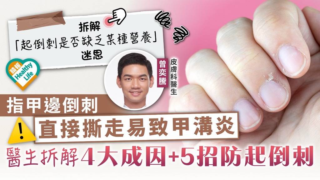 手指倒刺︳指甲邊倒刺 直接撕走易致甲溝炎 醫生拆解4大成因+5招防起倒刺