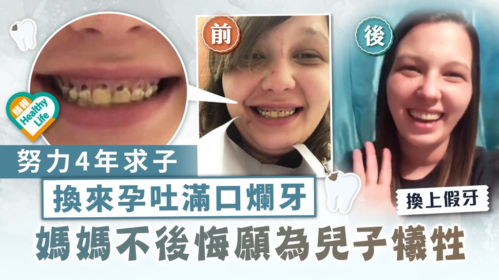 妊娠期牙齦炎 ︳努力4年求子換來孕吐滿口爛牙 媽媽不後悔願為兒子犧牲