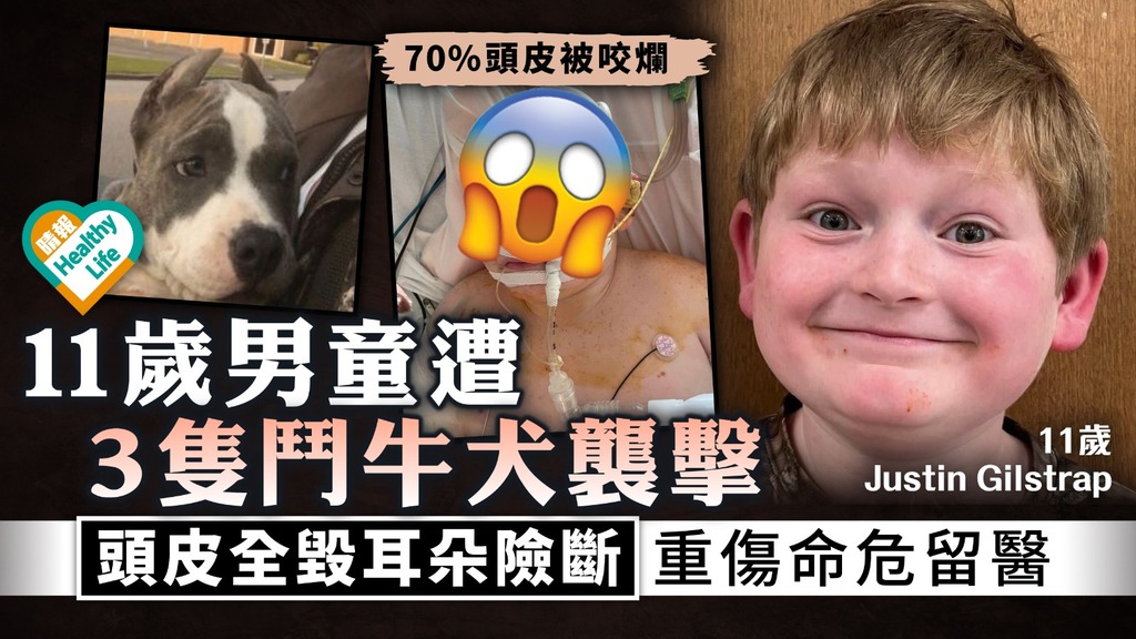 恐怖意外︳11歲男童遭3隻鬥牛犬襲擊 頭皮全毀耳朵險斷 重傷命危留醫