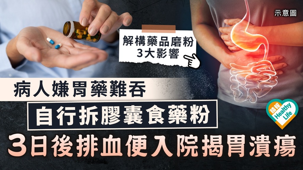 服藥須知｜糖尿患者嫌胃藥難吞 自行拆膠囊食藥粉 3日後排血便入院揭胃潰瘍