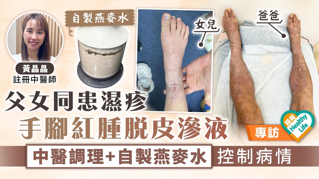 濕疹護理︳父女同患濕疹 手腳紅腫脫皮滲液 中醫調理+自製燕麥水控制病情