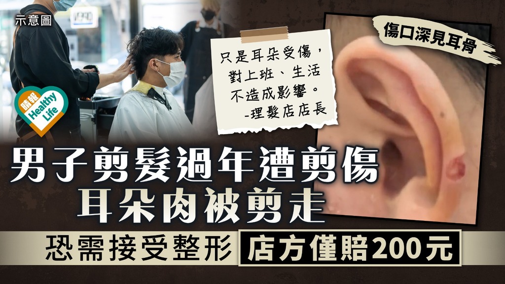 無妄之災︳男子剪髮過年遭剪傷 耳朵肉被剪走 恐需接受整形 店方僅賠200元