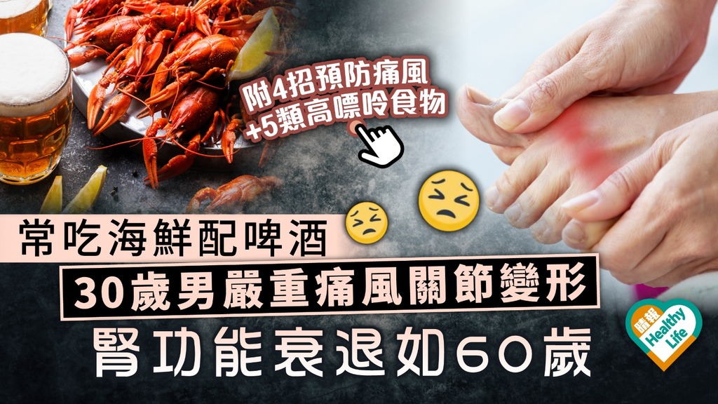 小心痛風︳30歲男常吃海鮮配啤酒 嚴重痛風關節變形 腎功能衰退如60歲︳附預防痛風4大貼士