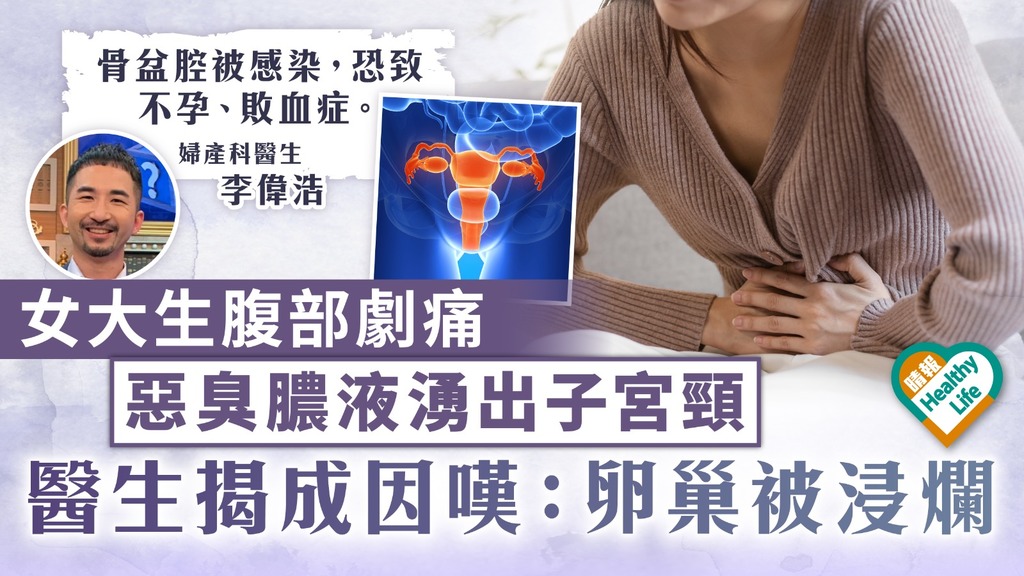 女士注意︳女大生腹部劇痛 惡臭膿液湧出子宮頸 醫生揭成因嘆：卵巢被浸爛