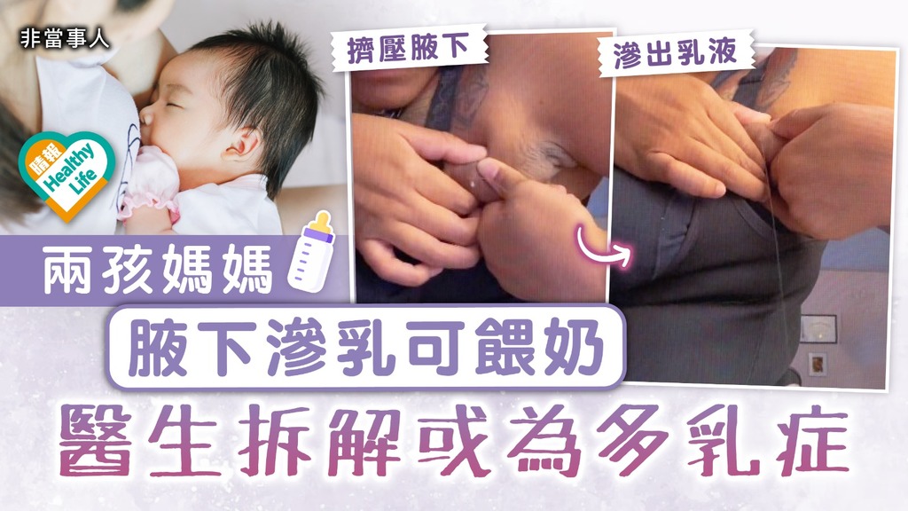 餵哺母乳｜兩孩媽媽腋下滲乳可餵奶 醫生拆解或為多乳症