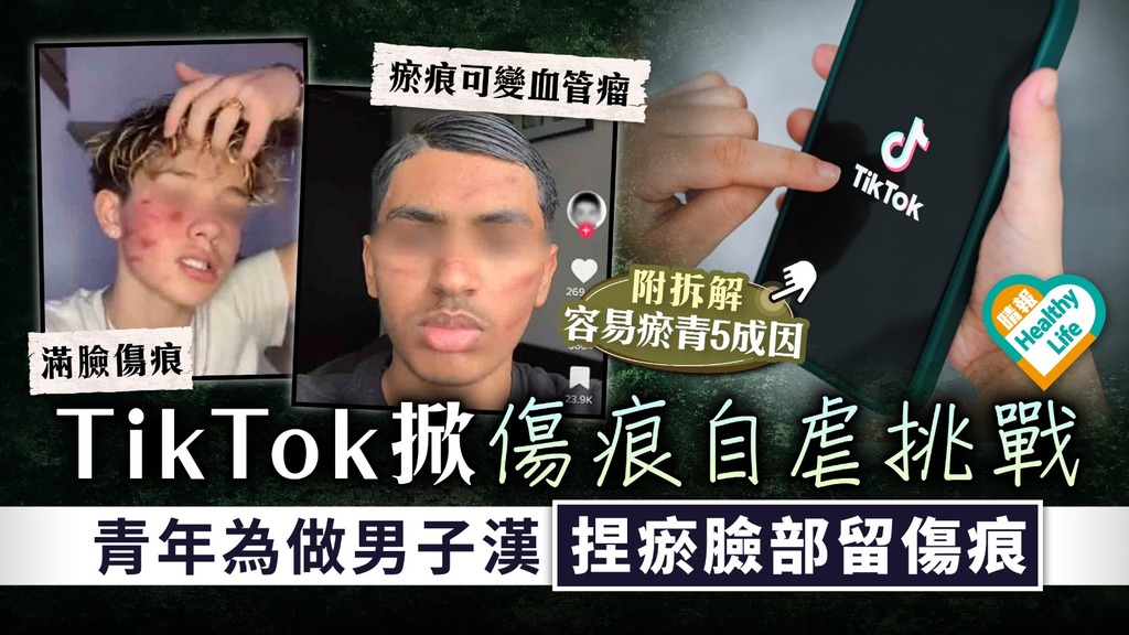 切勿模仿︳TikTok掀傷痕自虐挑戰 青年為做「男子漢」 捏瘀臉部留傷痕