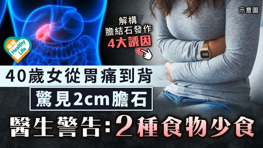 腸胃健康︳40歲女從胃痛到背 檢查驚見2cm膽結石 醫生警告：2種食物少食