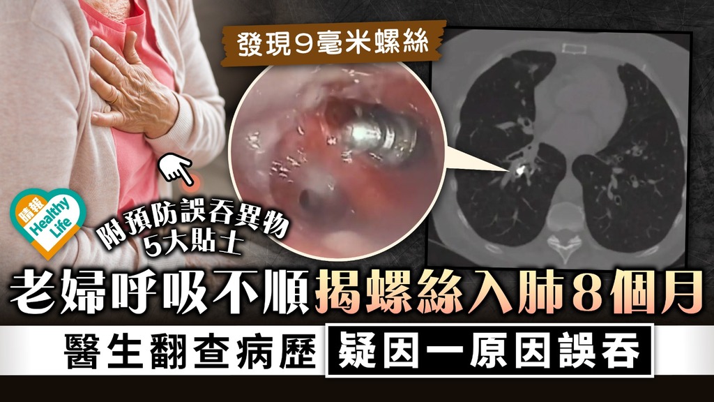 誤吞異物︳老婦呼吸不順揭螺絲入肺8個月 醫生翻查病歷疑因一原因誤吞︳附預防誤吞異物5大貼士