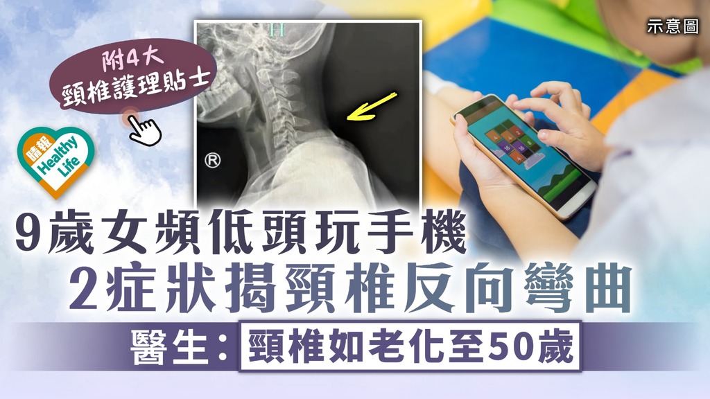 低頭族︳9歲女頻低頭玩手機 2症狀揭頸椎反向彎曲 醫生：如老化至50歲