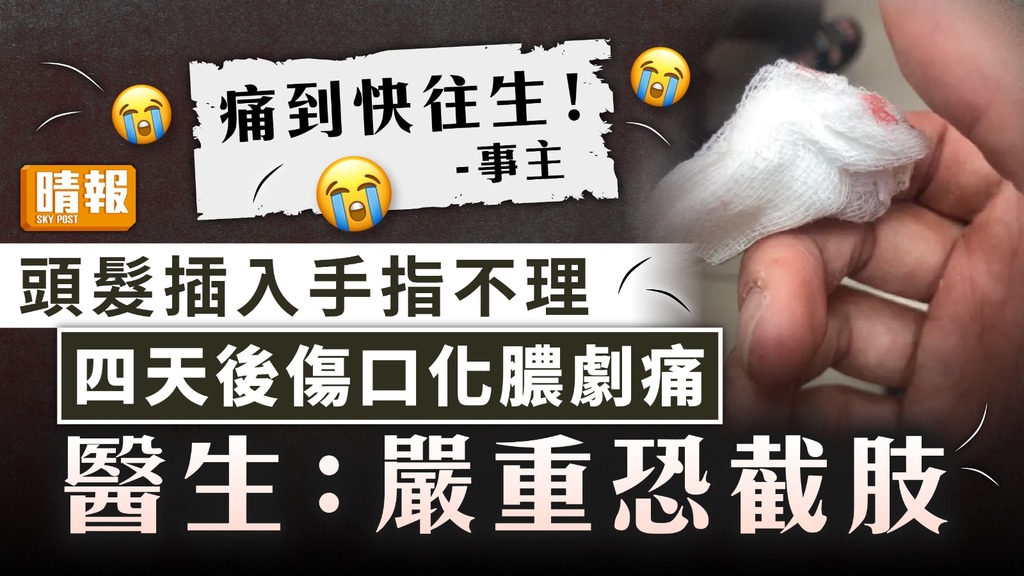 異物插入｜頭髮插入手指不理四天後傷口化膿劇痛 醫生：嚴重恐截肢
