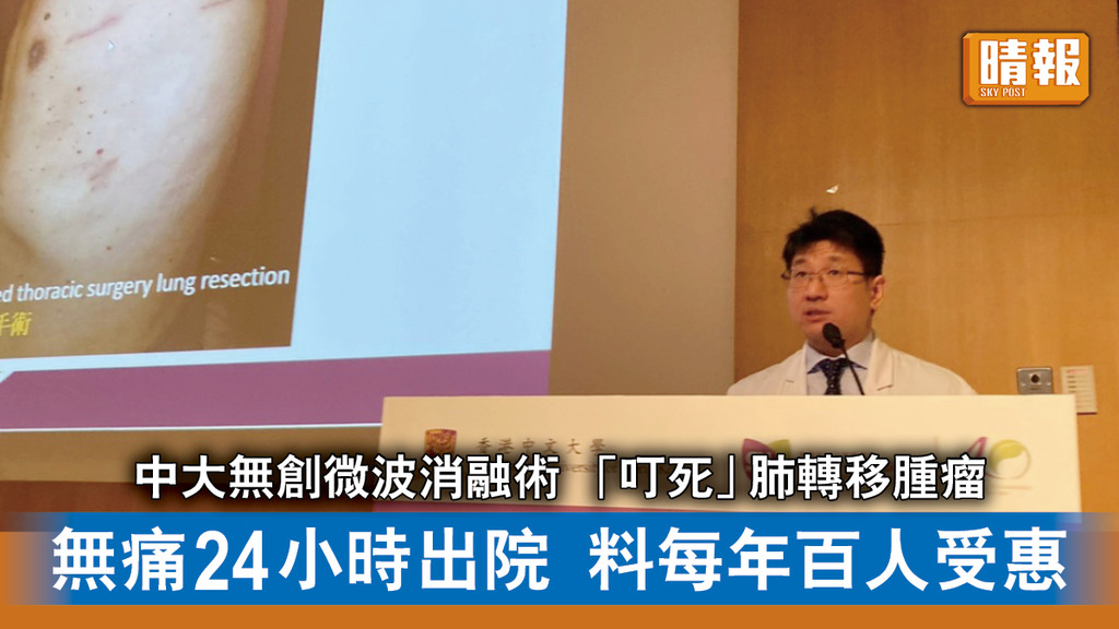 癌症治療｜中大無創微波消融術「叮死」肺轉移腫瘤 無痛24小時可出院 料每年百人受惠