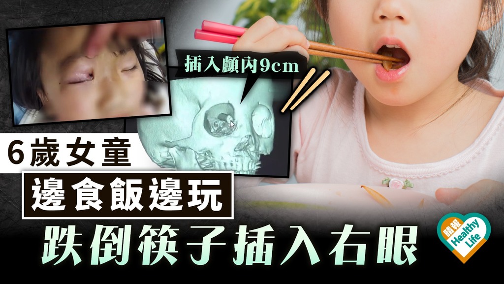 恐怖意外｜6歲女童邊食飯邊玩 跌倒筷子插右眼深入顱內9cm